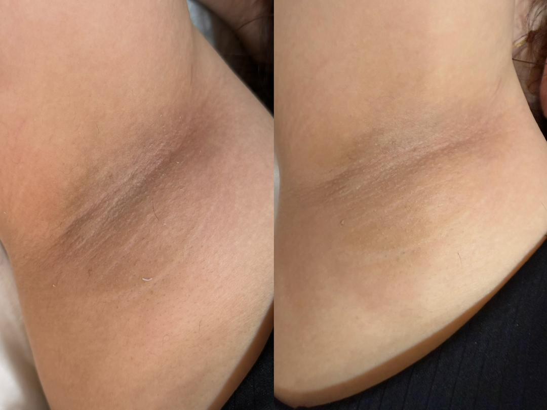 SPECTRA 4 Hair Removal result 2