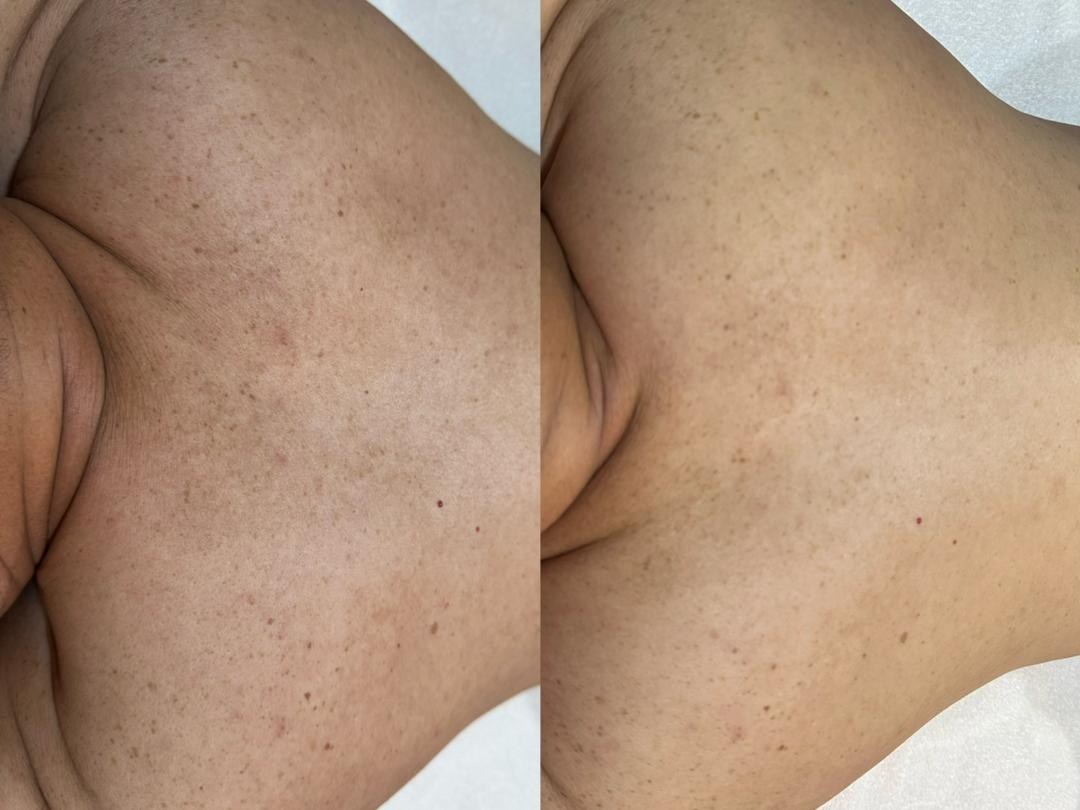 SPECTRA 4 Hair Removal result 3