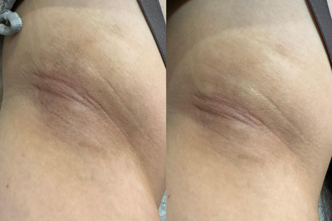 Mela-X Treatment result 1