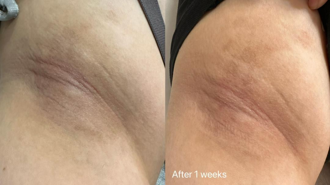 Mela-X Treatment result 2
