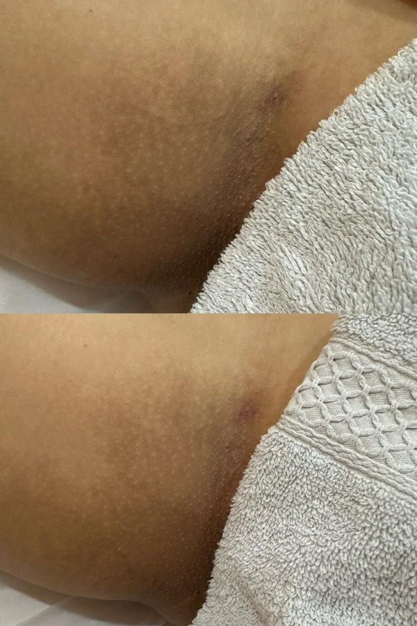 Mela-X Treatment result 3